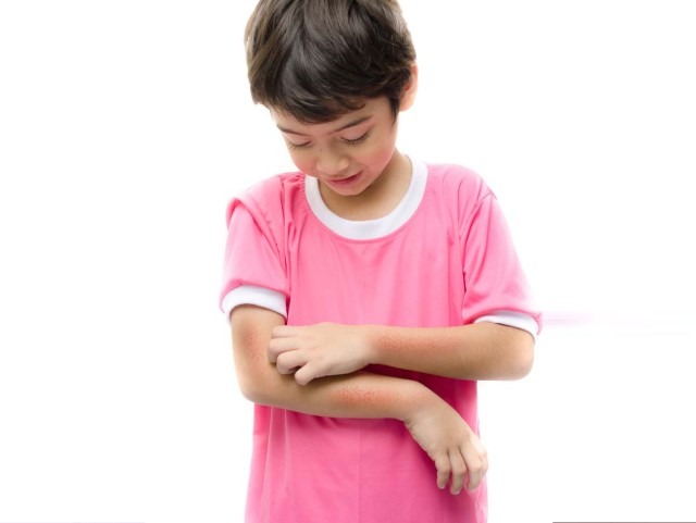 Coping with Childhood Eczema