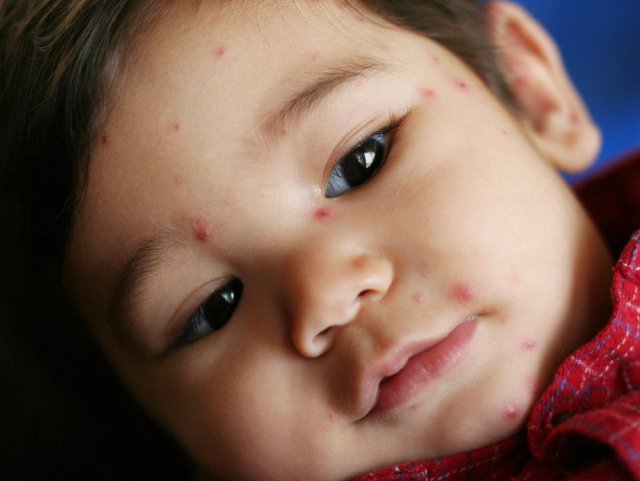 Rashes and Spots on your Tiny Tots